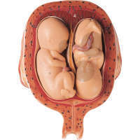 Utérus avec fœtus jumeaux au 5e mois