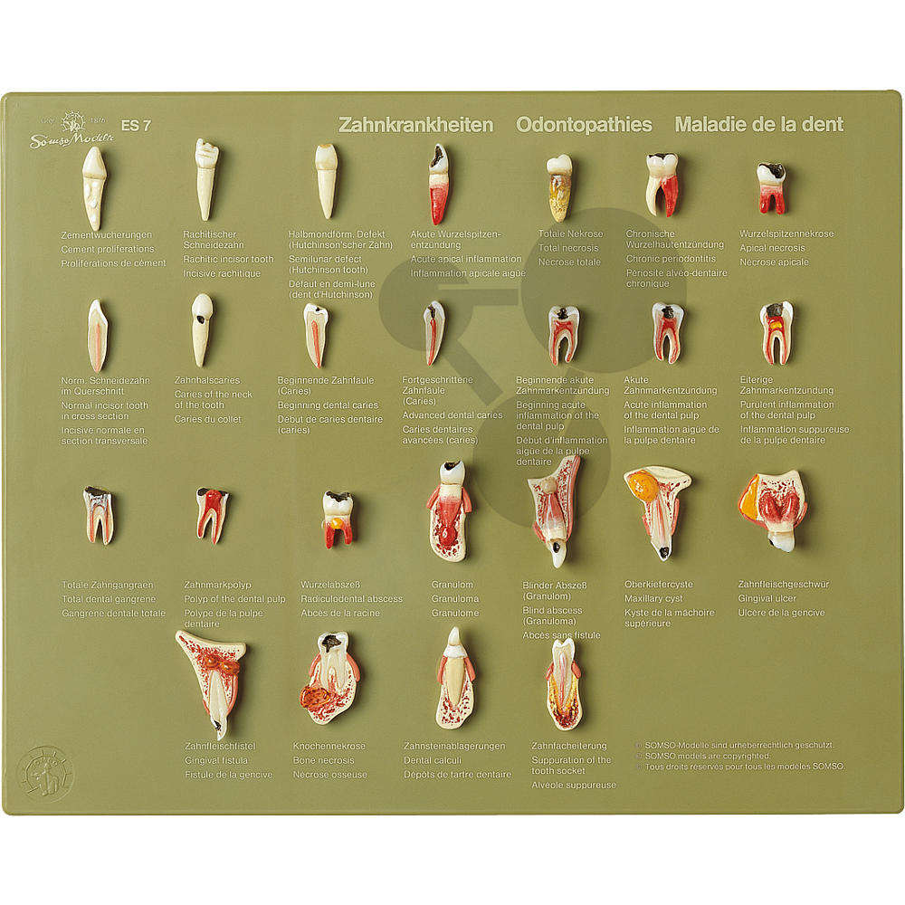 Schaukasten "Zahnkrankheiten" SOMSO®-Modell
