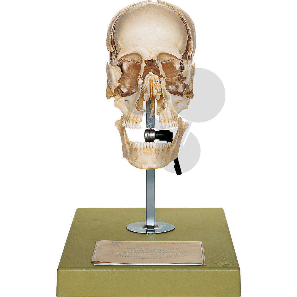 Crâne humain éclaté
