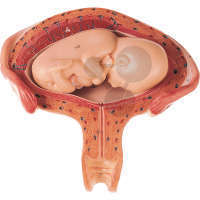 Utérus avec foetus dans le 4. - 5. mois
