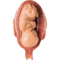 Utérus avec fœtus au 7° mois